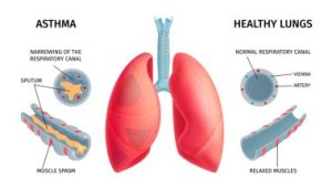 Starting Out Exercising With Asthma