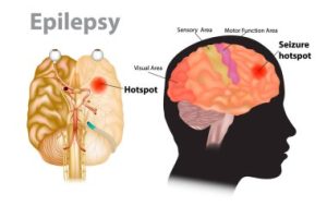 Can Epilepsy People Exercise And Play Sports