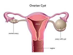 Can You Exercise With An Ovarian Cyst