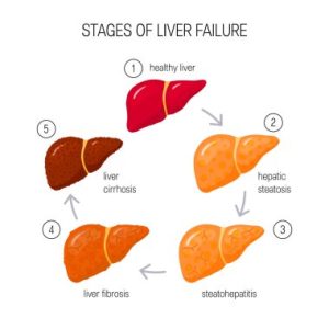 Best Exercise For Healthy Liver
