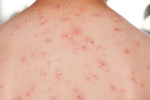 Can You Exercise With Chicken Pox