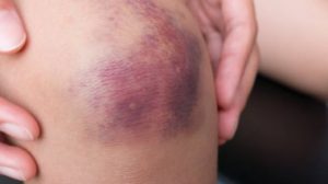 Can Exercise Cause Bruising