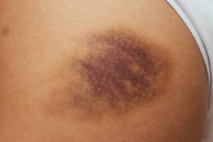 Can Exercise Cause Bruising