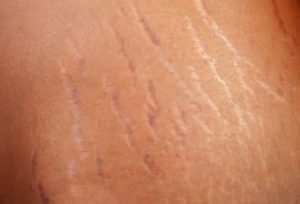 Can Exercise Get Rid Of Stretch Marks
